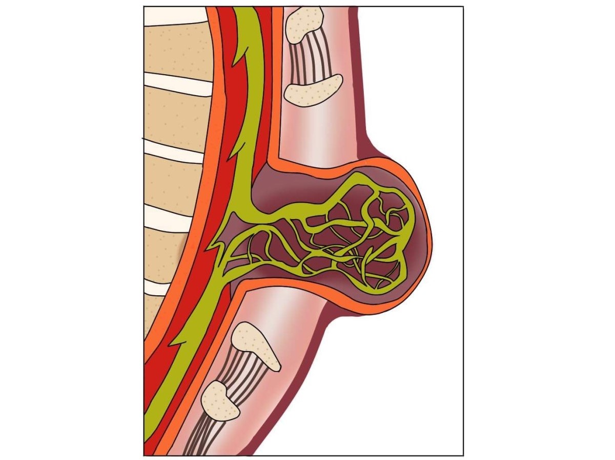 Myelomeningocele, een open spina bifida met verplaatsing van het ruggenmerg en de ruggenmergzenuwen.